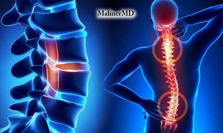 Spinal Fracture Doctor in Florida